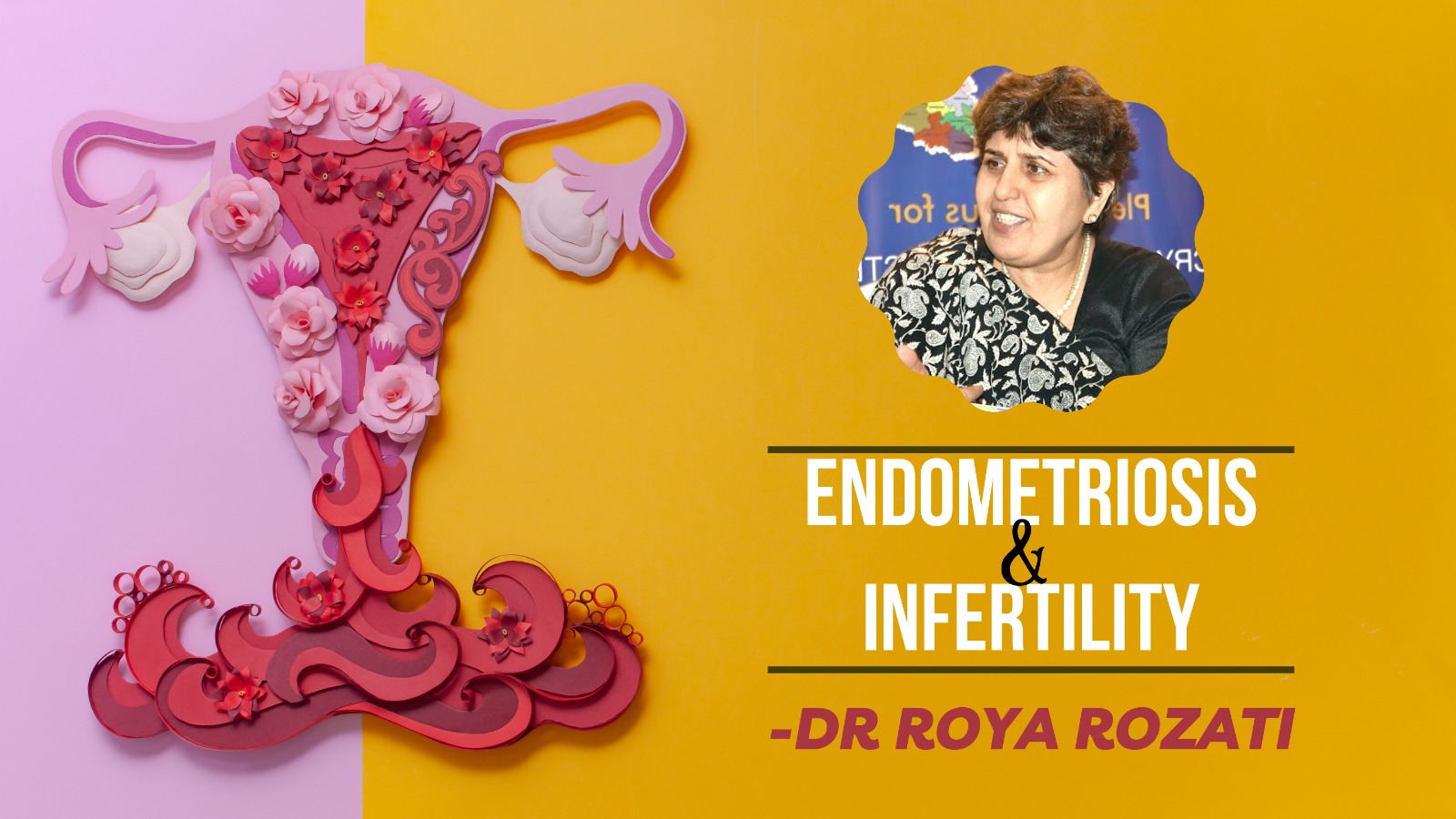 Endometriosis and Infertility: Insights from an Infertility Specialist