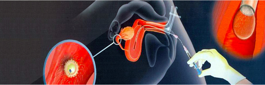 INTRA-UTERINE INSEMINATION (IUI)